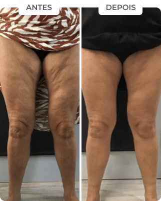 antes-depois-1