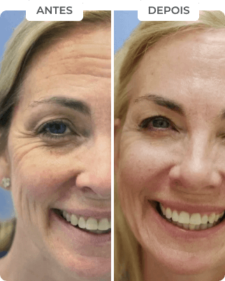 antes-depois-2