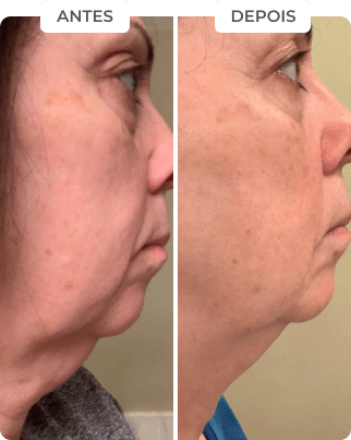 antes-depois-4