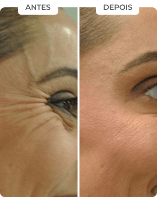 antes-depois-5