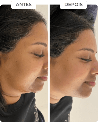 antes-depois-9